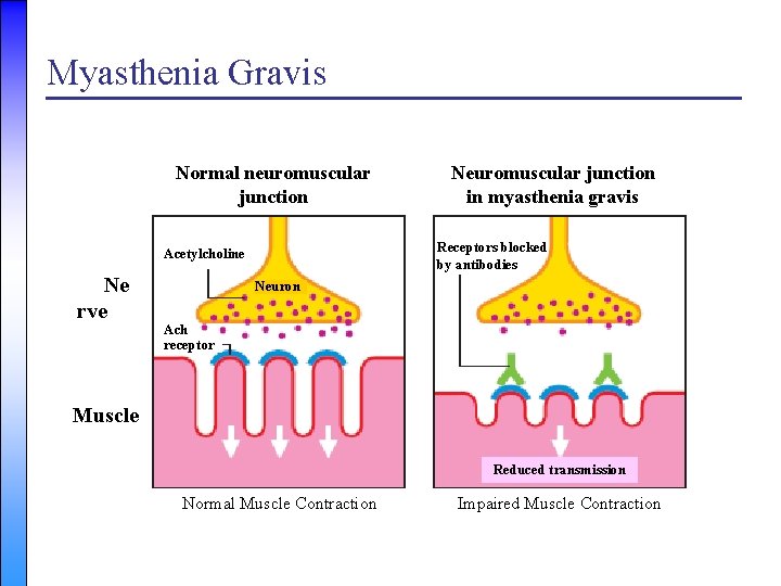Myasthenia Gravis Normal neuromuscular junction Receptors blocked by antibodies Acetylcholine Ne rve Neuromuscular junction
