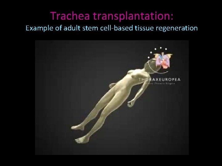 Trachea transplantation: Example of adult stem cell-based tissue regeneration 