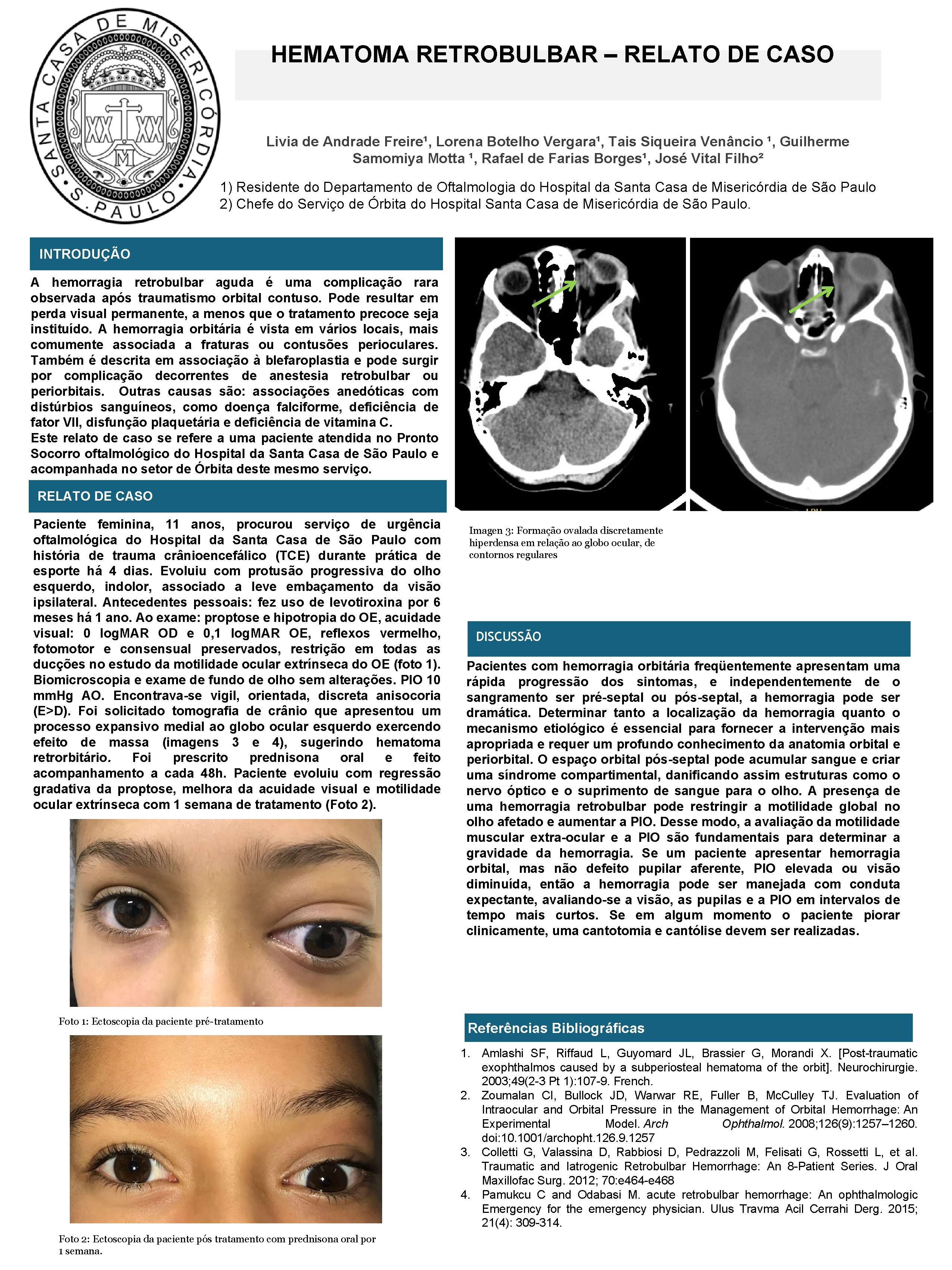 HEMATOMA RETROBULBAR – RELATO DE CASO Livia de Andrade Freire¹, Lorena Botelho Vergara¹, Tais