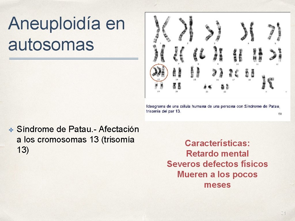 Aneuploidía en autosomas ✤ Síndrome de Patau. - Afectación a los cromosomas 13 (trisomía