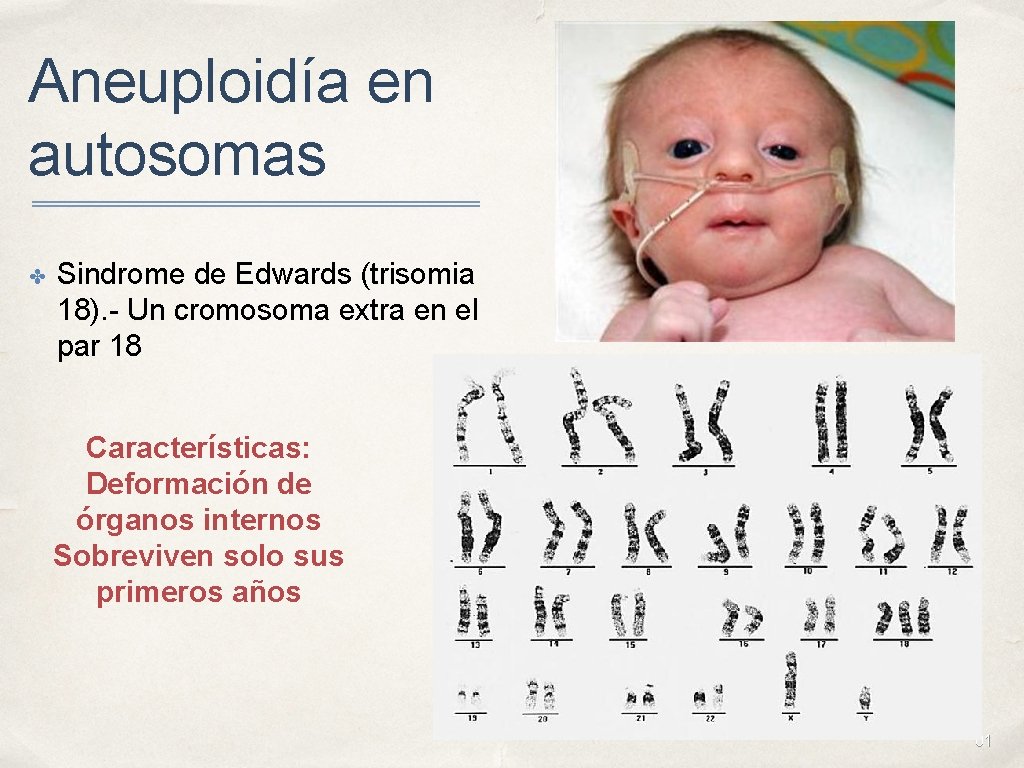 Aneuploidía en autosomas ✤ Sindrome de Edwards (trisomia 18). - Un cromosoma extra en