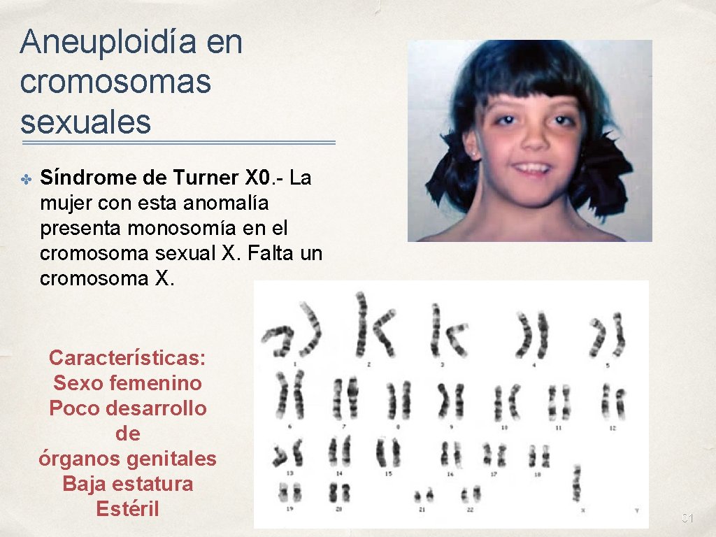 Aneuploidía en cromosomas sexuales ✤ Síndrome de Turner X 0. - La mujer con