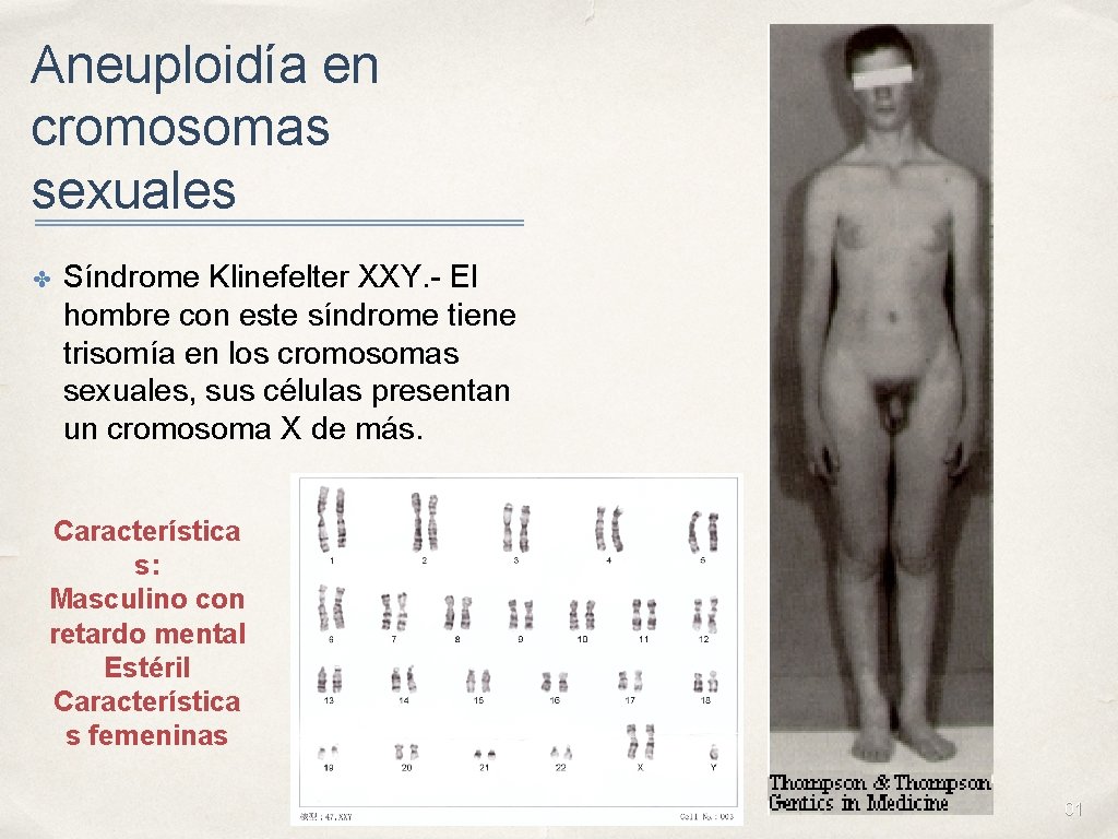 Aneuploidía en cromosomas sexuales ✤ Síndrome Klinefelter XXY. - El hombre con este síndrome