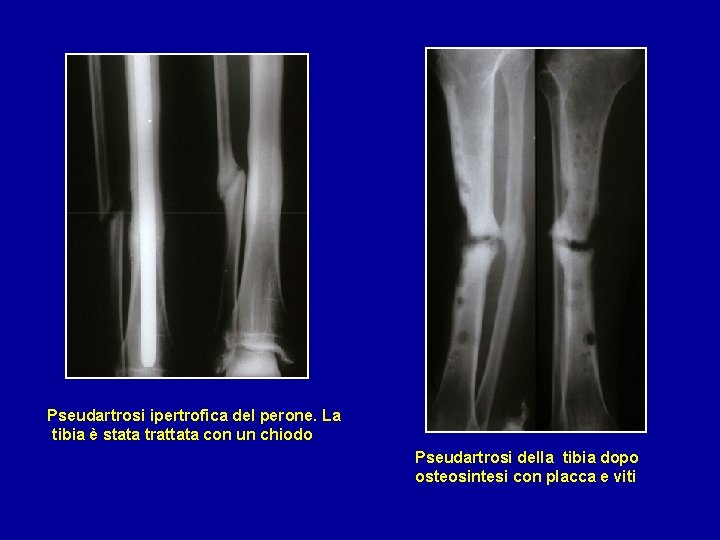  Pseudartrosi ipertrofica del perone. La tibia è stata trattata con un chiodo Pseudartrosi