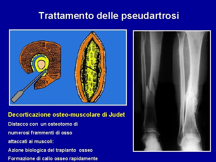 Trattamento delle pseudartrosi Decorticazione osteo-muscolare di Judet Distacco con un osteotomo di numerosi frammenti