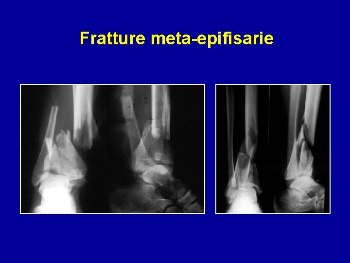 Fratture meta-epifisarie 