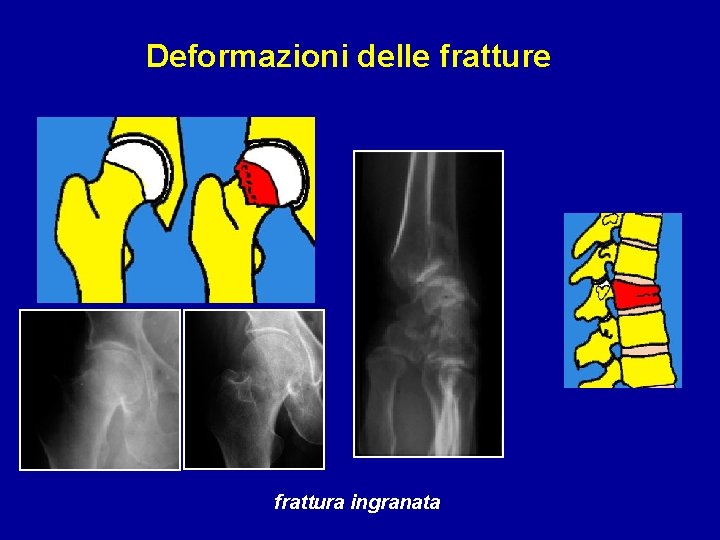 Deformazioni delle fratture frattura ingranata 
