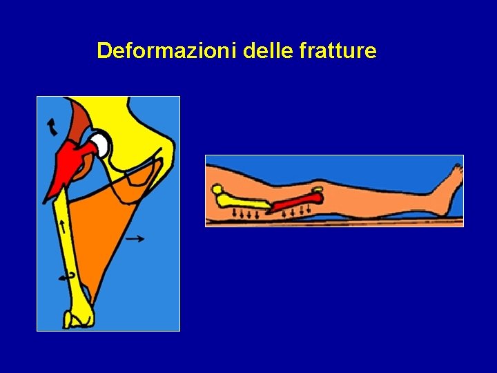 Deformazioni delle fratture 