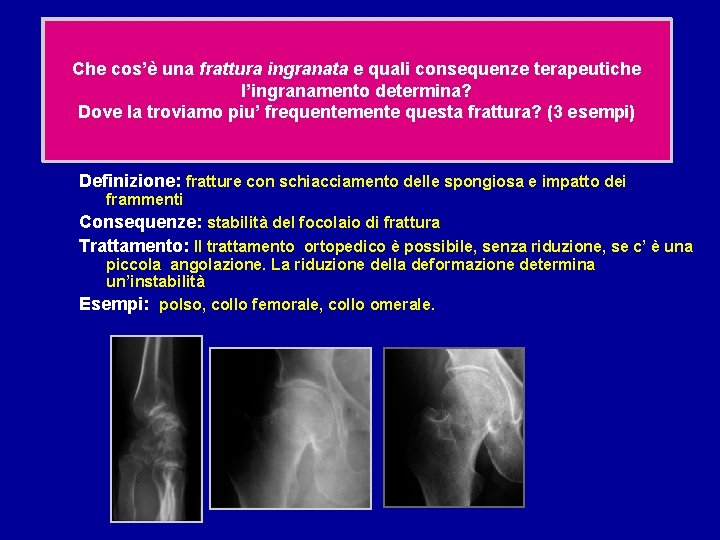 Qu'est-ce qu'une fracture engrenée et quelles conséquences Che cos’è una frattura ingranata e quali