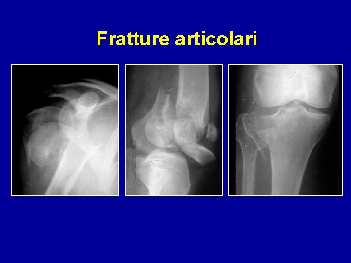 Fratture articolari 