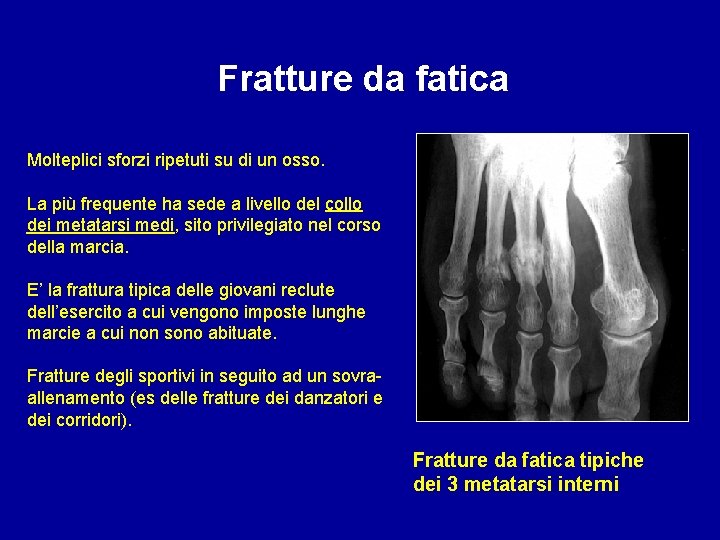 Fratture da fatica Molteplici sforzi ripetuti su di un osso. La più frequente ha