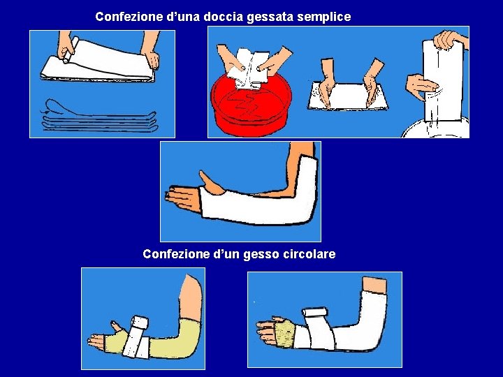 Confezione d’una doccia gessata semplice Confezione d’un gesso circolare 