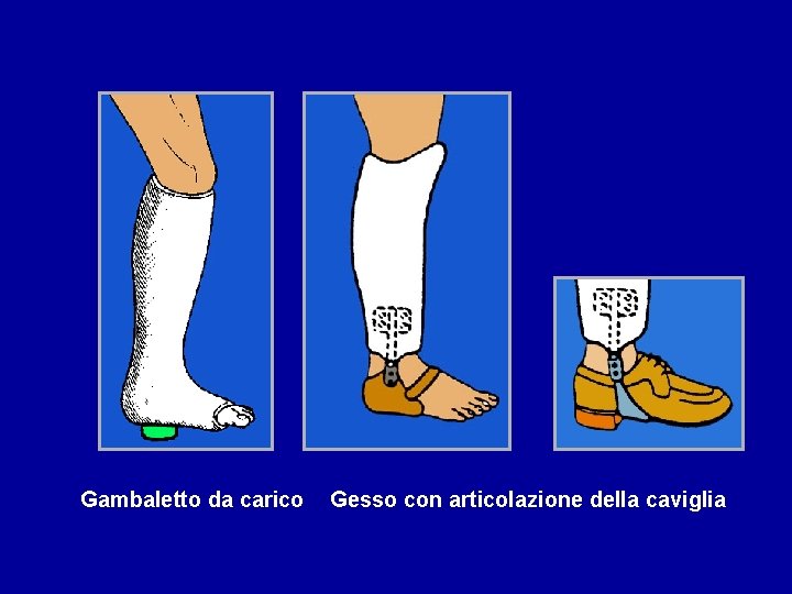 Gambaletto da carico Gesso con articolazione della caviglia 
