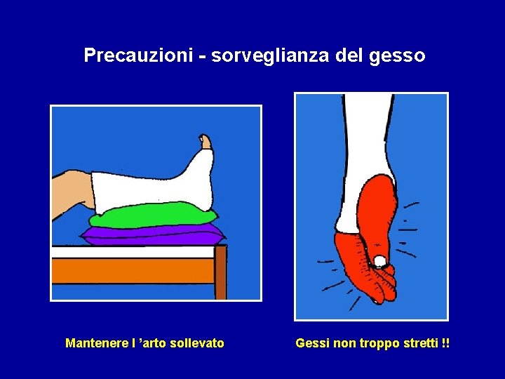 Precauzioni - sorveglianza del gesso Mantenere l ’arto sollevato Gessi non troppo stretti !!