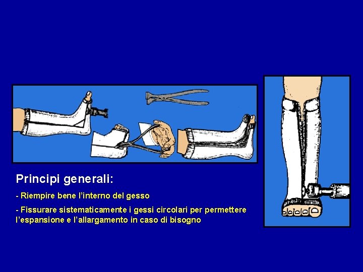 Principi generali: - Riempire bene l’interno del gesso - Fissurare sistematicamente i gessi circolari