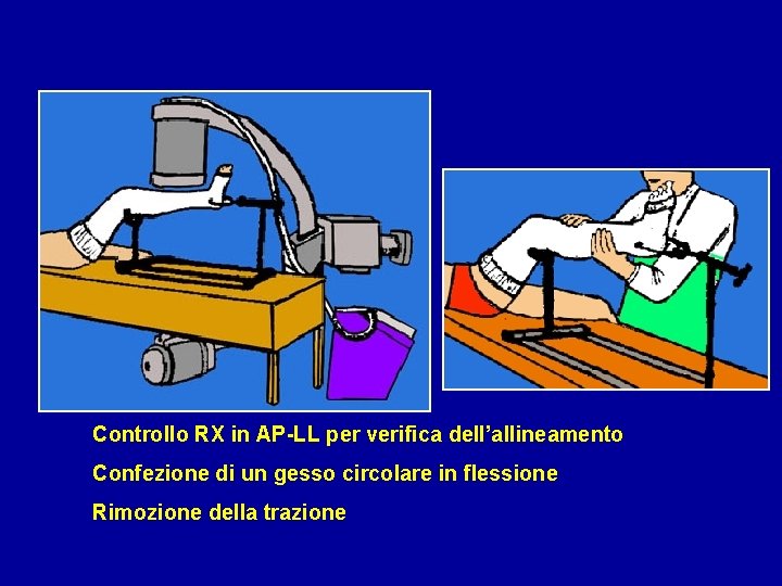  Controllo RX in AP-LL per verifica dell’allineamento Confezione di un gesso circolare in