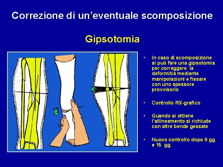 Correzione di un’eventuale scomposizione Gipsotomia • In caso di scomposizione si può fare una