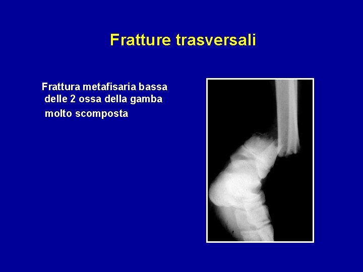 Fratture trasversali Frattura metafisaria bassa delle 2 ossa della gamba molto scomposta 