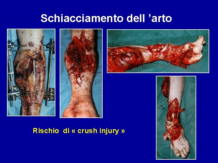 Schiacciamento dell ’arto Rischio di « crush injury » 