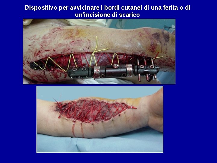 Dispositivo per avvicinare i bordi cutanei di una ferita o di un’incisione di scarico