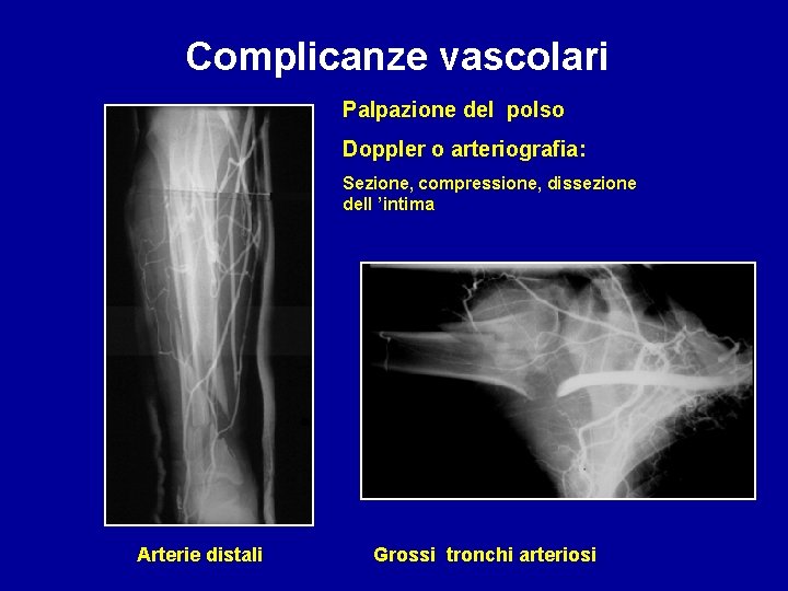 Complicanze vascolari Palpazione del polso Doppler o arteriografia: Sezione, compressione, dissezione dell ’intima Arterie