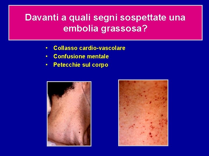 Davanti a quali segni sospettate una embolia grassosa? • Collasso cardio-vascolare • Confusione mentale