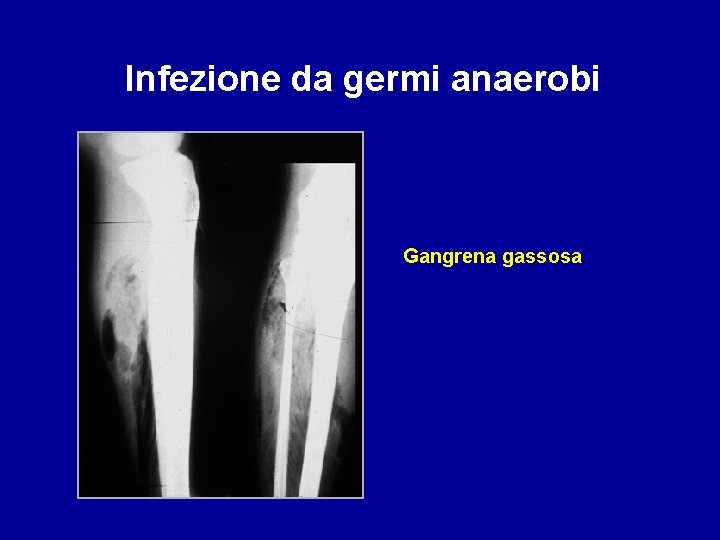 Infezione da germi anaerobi Gangrena gassosa 