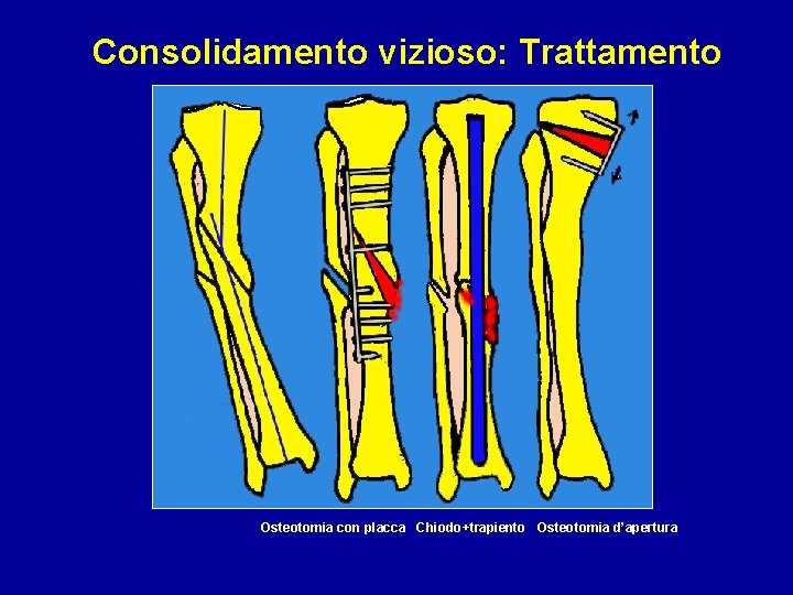 Consolidamento vizioso: Trattamento Osteotomia con placca Chiodo+trapiento Osteotomia d’apertura 