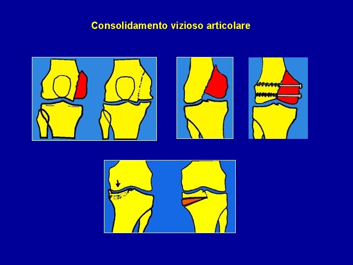 Consolidamento vizioso articolare 