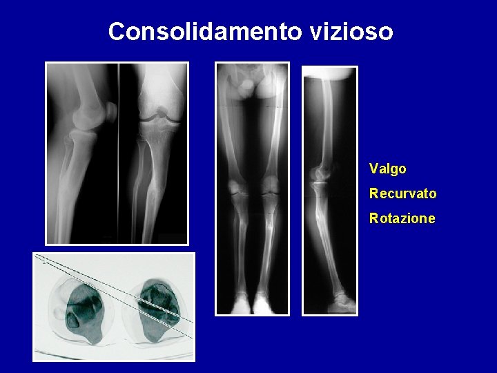 Consolidamento vizioso Valgo Recurvato Rotazione 