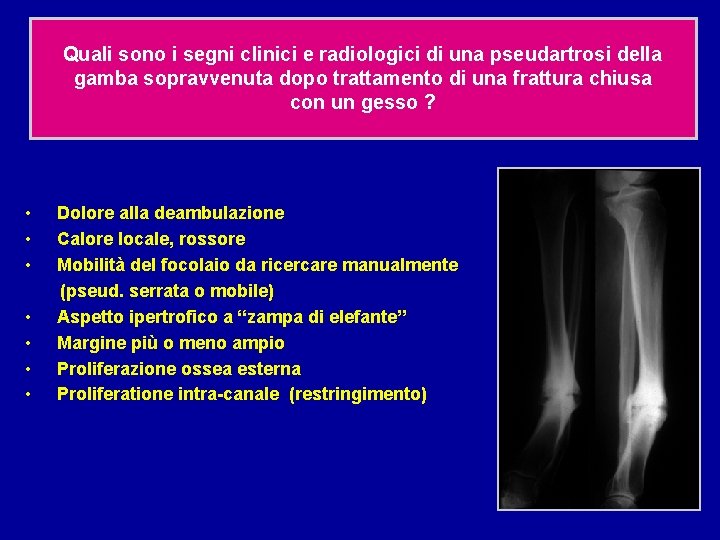 Quali sono i segni clinici e radiologici di una pseudartrosi della gamba sopravvenuta dopo