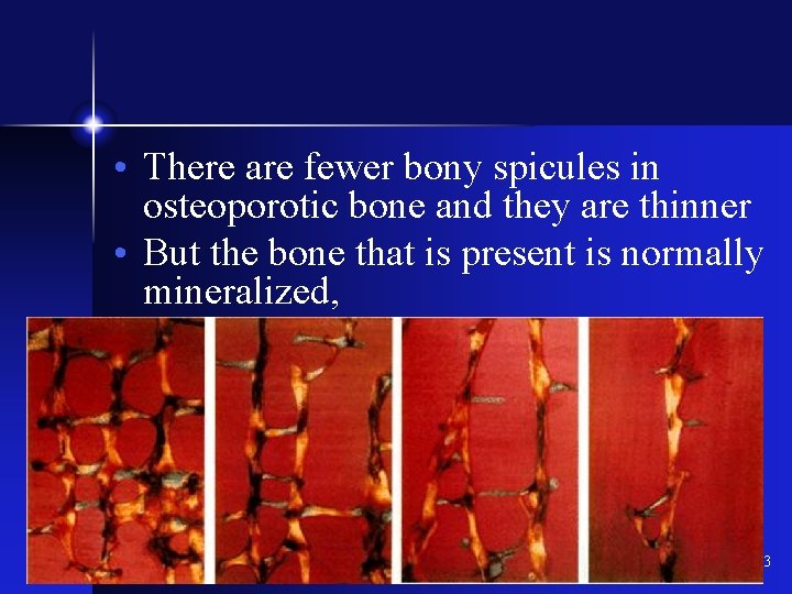 • There are fewer bony spicules in osteoporotic bone and they are thinner