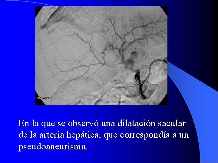 En la que se observó una dilatación sacular de la arteria hepática, que correspondía