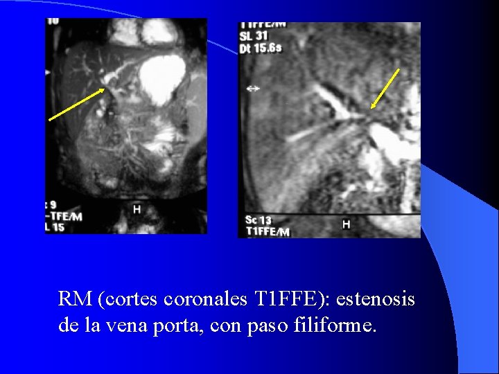 RM (cortes coronales T 1 FFE): estenosis de la vena porta, con paso filiforme.