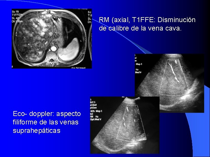 RM (axial, T 1 FFE: Disminución de calibre de la vena cava. Eco- doppler: