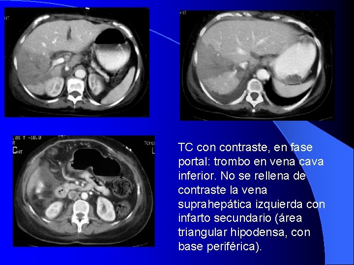 TC contraste, en fase portal: trombo en vena cava inferior. No se rellena de