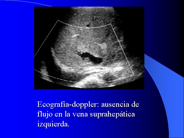 Ecografía-doppler: ausencia de flujo en la vena suprahepática izquierda. 