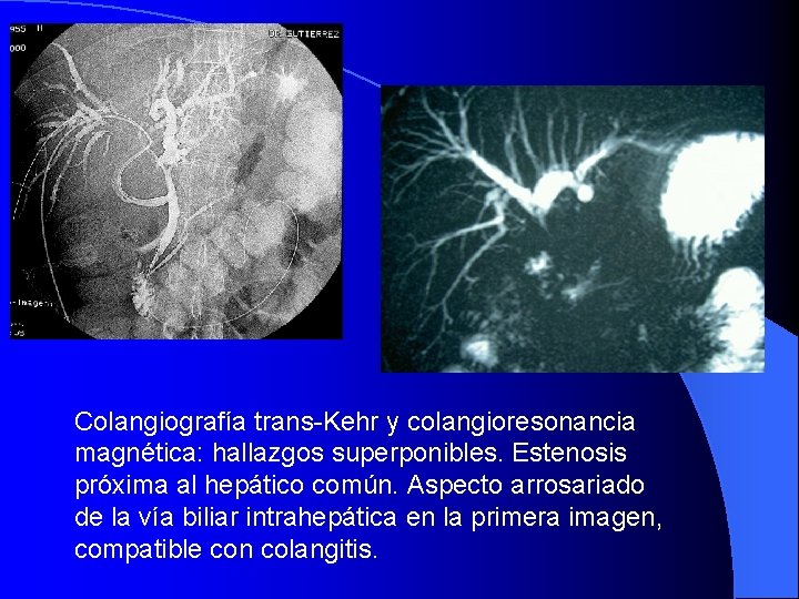 Colangiografía trans-Kehr y colangioresonancia magnética: hallazgos superponibles. Estenosis próxima al hepático común. Aspecto arrosariado