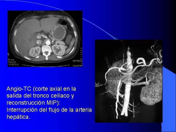 Angio-TC (corte axial en la salida del tronco celíaco y reconstrucción MIP): Interrupción del