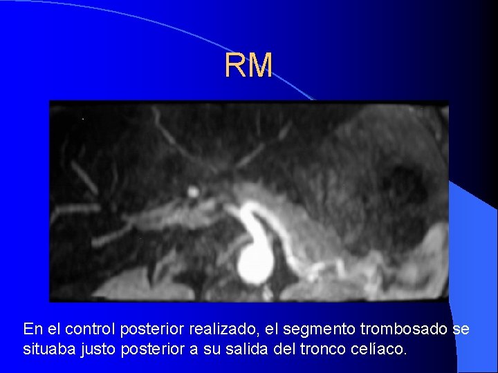 RM En el control posterior realizado, el segmento trombosado se situaba justo posterior a