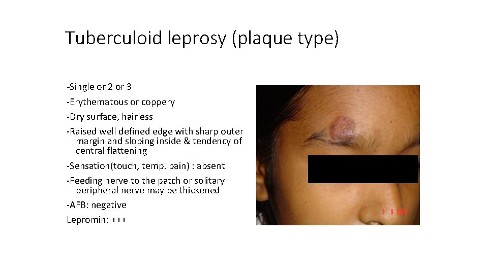 Tuberculoid leprosy (plaque type) -Single or 2 or 3 -Erythematous or coppery -Dry surface,