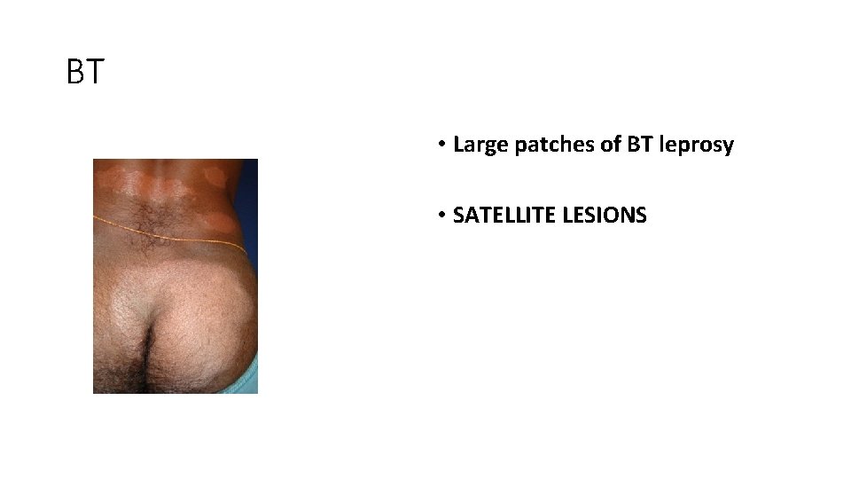 BT • Large patches of BT leprosy • SATELLITE LESIONS 