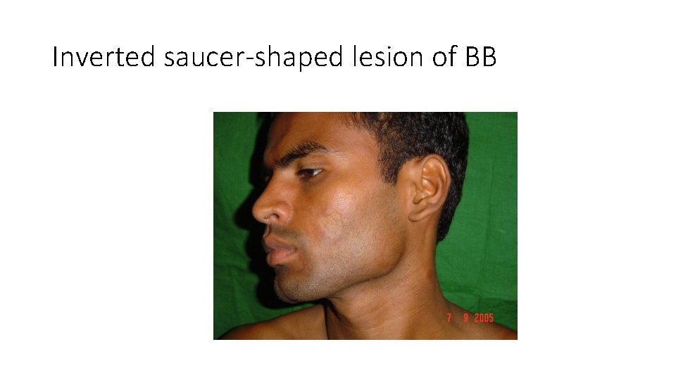 Inverted saucer-shaped lesion of BB 