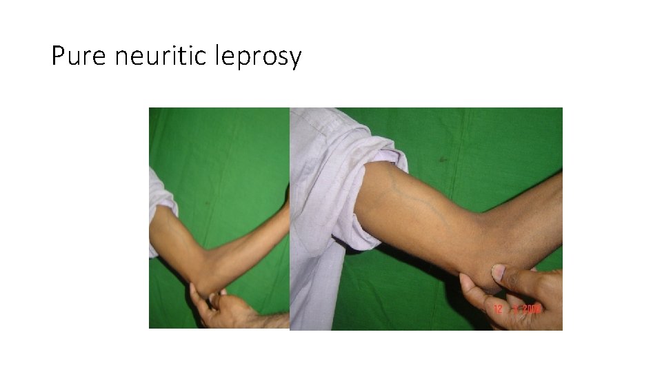 Pure neuritic leprosy 