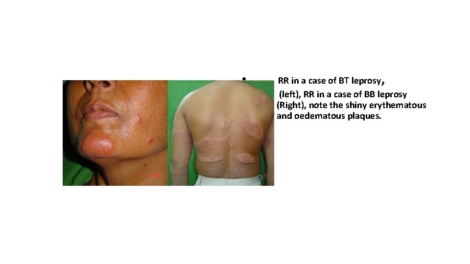  • RR in a case of BT leprosy, (left), RR in a case