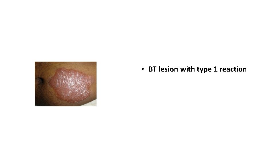  • BT lesion with type 1 reaction 