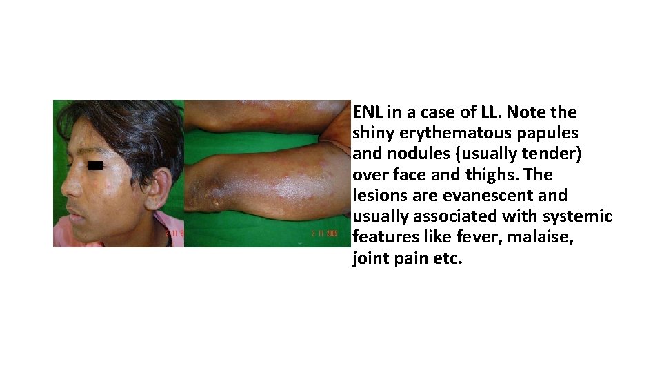  • ENL in a case of LL. Note the shiny erythematous papules and