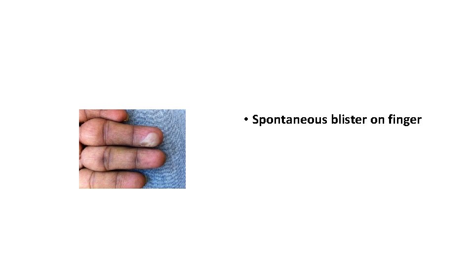  • Spontaneous blister on finger 