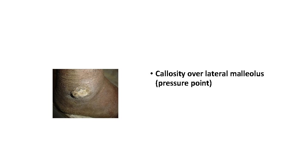  • Callosity over lateral malleolus (pressure point) 