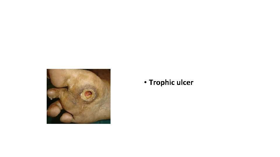  • Trophic ulcer 